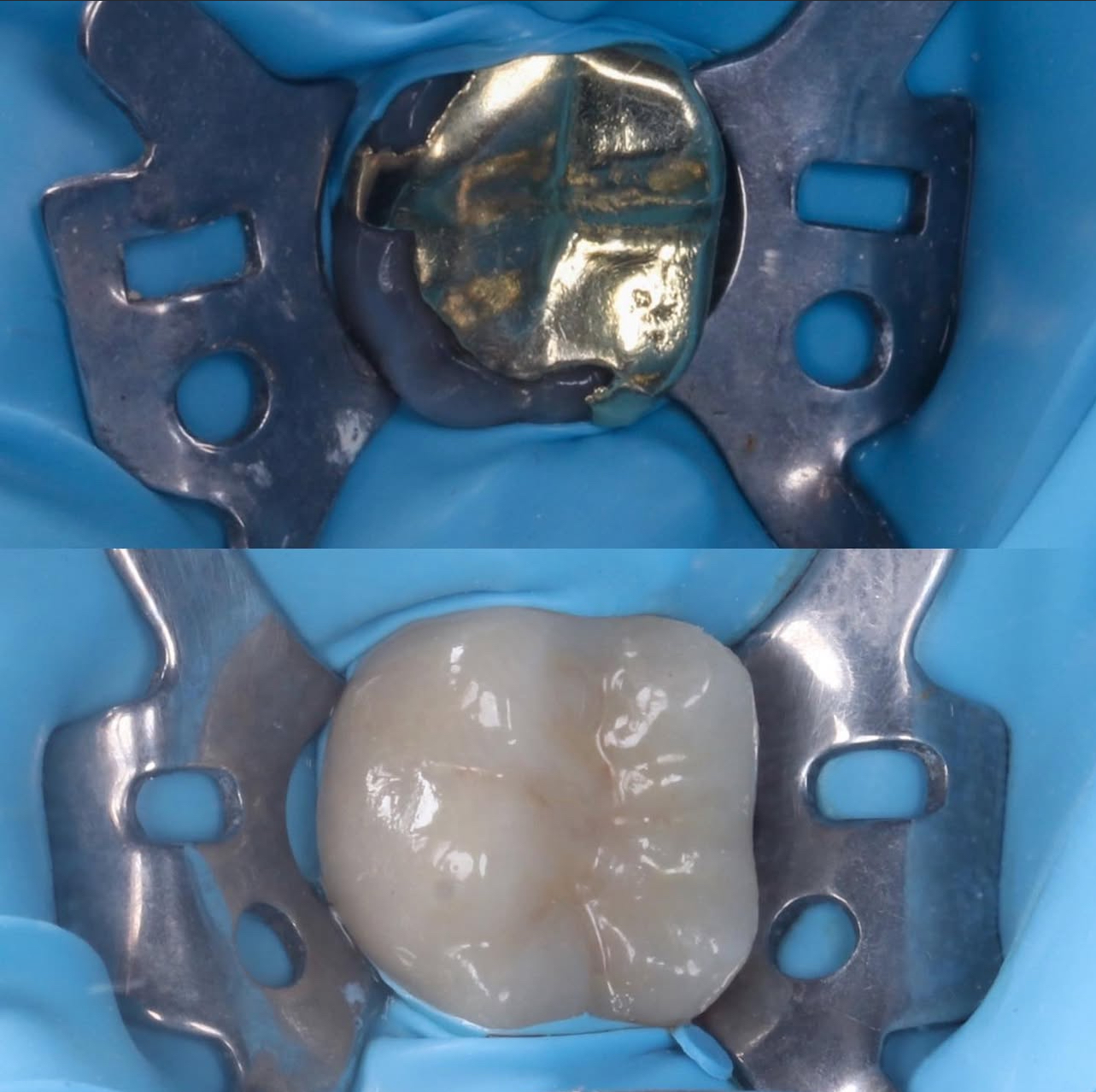 Rehabilitación Adhesiva